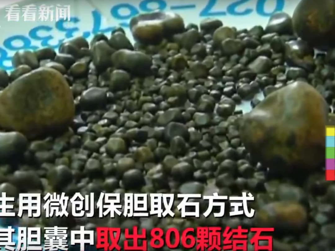 แพทย์จีนพบก้อนนิ่วกว่า 800 ก้อน อยู่ในตัวคุณยาย