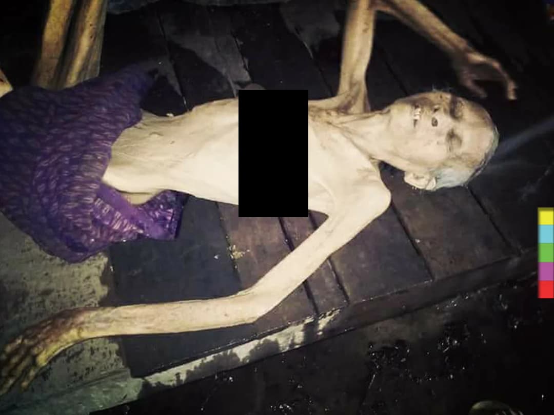 สุดสงสาร ! ยาย 84 ป่วยเชื้อรากินกระดูก ตาบอด ไร้คนดูแล ซ้ำไร้สิทธิ์รักษา