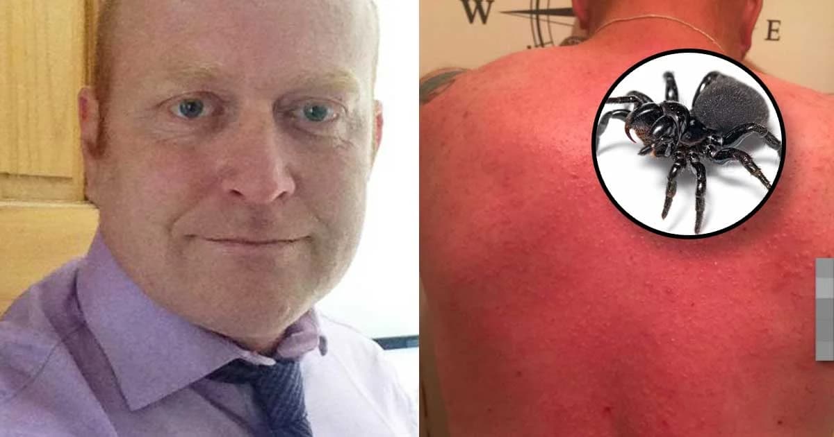 หนุ่มอังกฤษแพ้พิษแมงมุมหนัก เกือบหวิดดับ