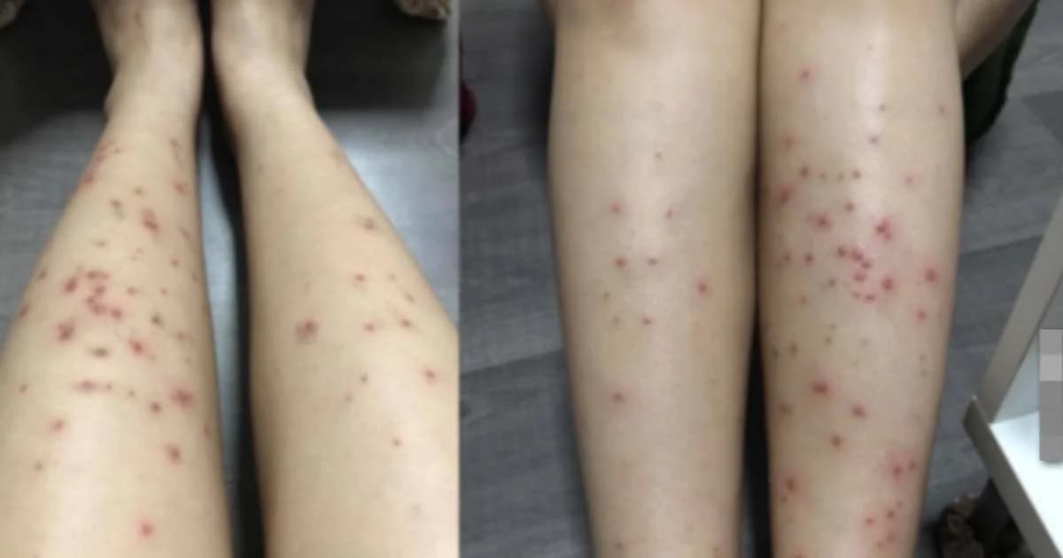 เตือนภัย! สาวโพสต์ “แวกซ์ขนขา” หน้าแข้งพัง ร้านไม่รับผิดชอบ