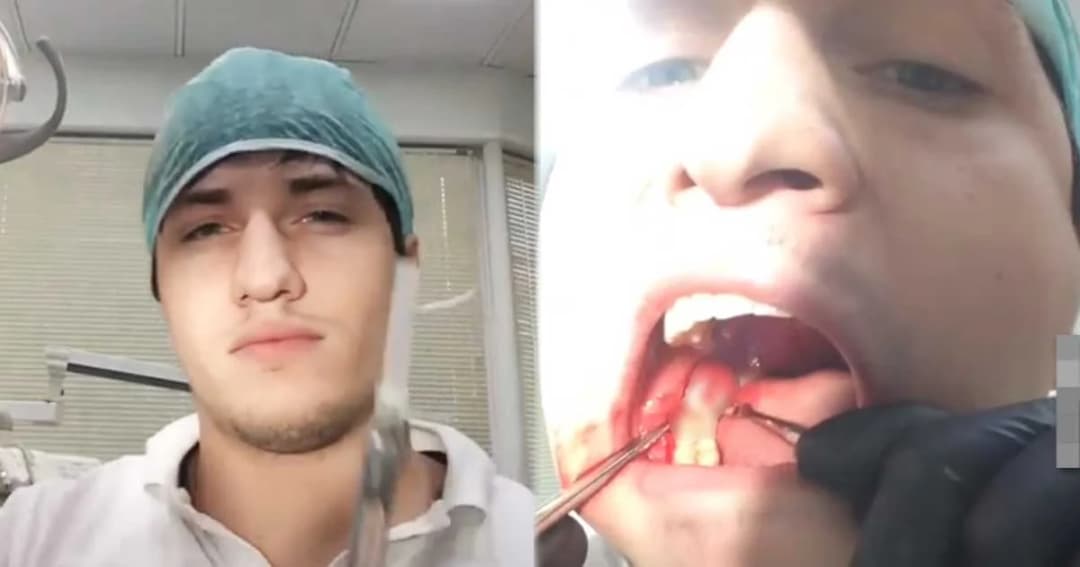 หมอฟันหนุ่มปวดฟันคุดหนัก โชว์ทักษะถอนฟันด้วยตัวเอง