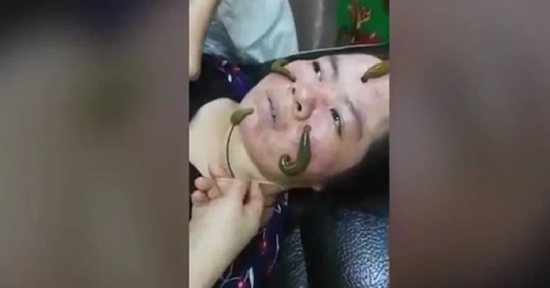 ชวนขนลุก! สาวจีนฮิต ใช้ปลิงรักษาสิวให้หน้าใส