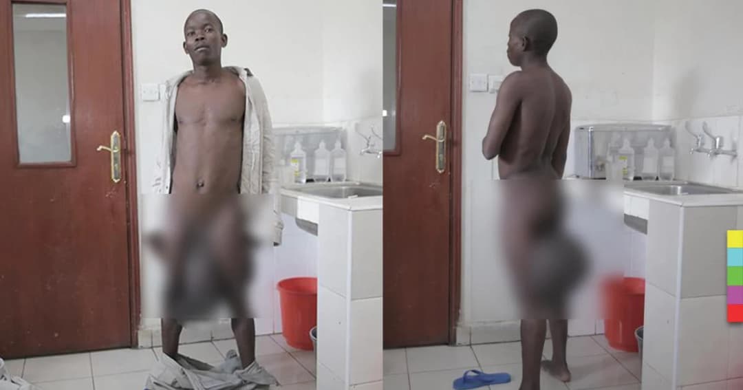 หนุ่ม ‘เจ้าโลกยักษ์’ ใหญ่ 20 เท่า ได้ชีวิตใหม่ หลังแพทย์ผ่าตัดสำเร็จ