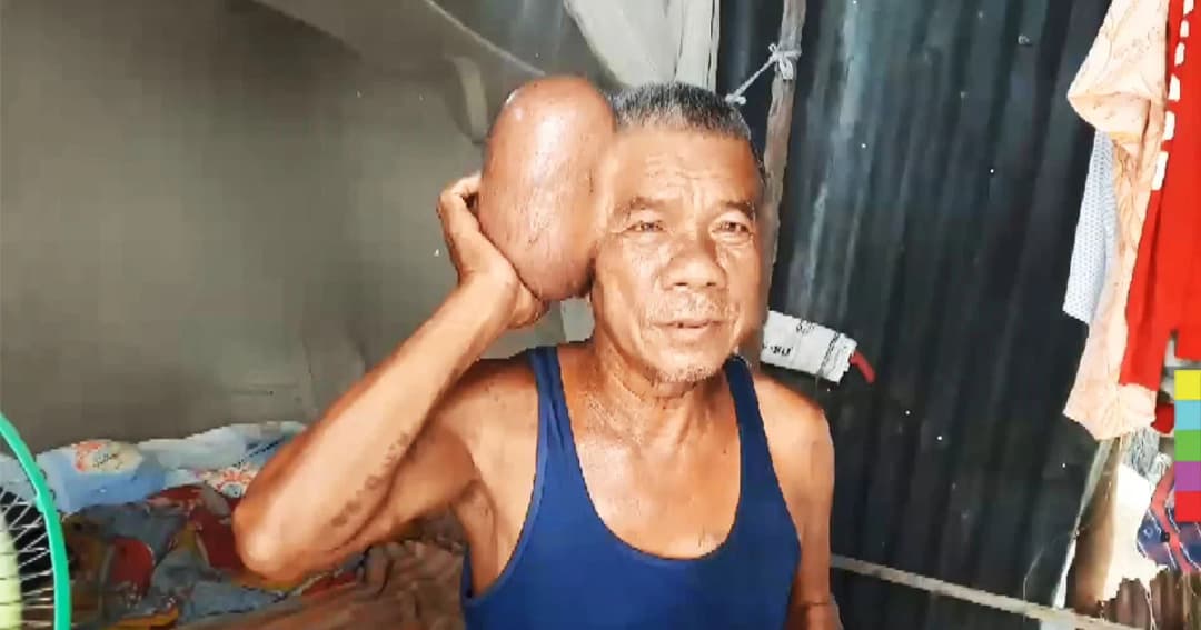 สุดรันทด ! พบชายชราวัย 71 ปี มีเนื้องอกข้างศีรษะ คล้าย ‘มนุษย์สองหัว’