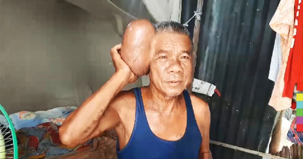 สุดรันทด ! พบชายชราวัย 71 ปี มีเนื้องอกข้างศีรษะ คล้าย ‘มนุษย์สองหัว’