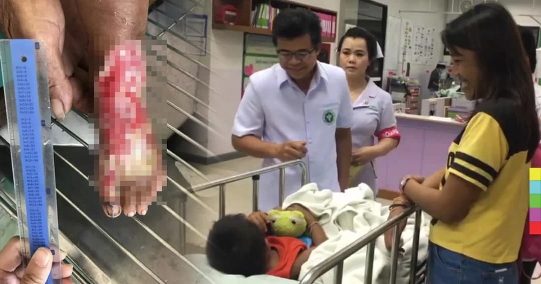 ผู้ว่าฯ ชัยภูมิ สั่งดูแล เด็ก 2 ขวบที่ถูกงูเหากัดขาแผลเริ่มเน่า จนกว่าจะหาย