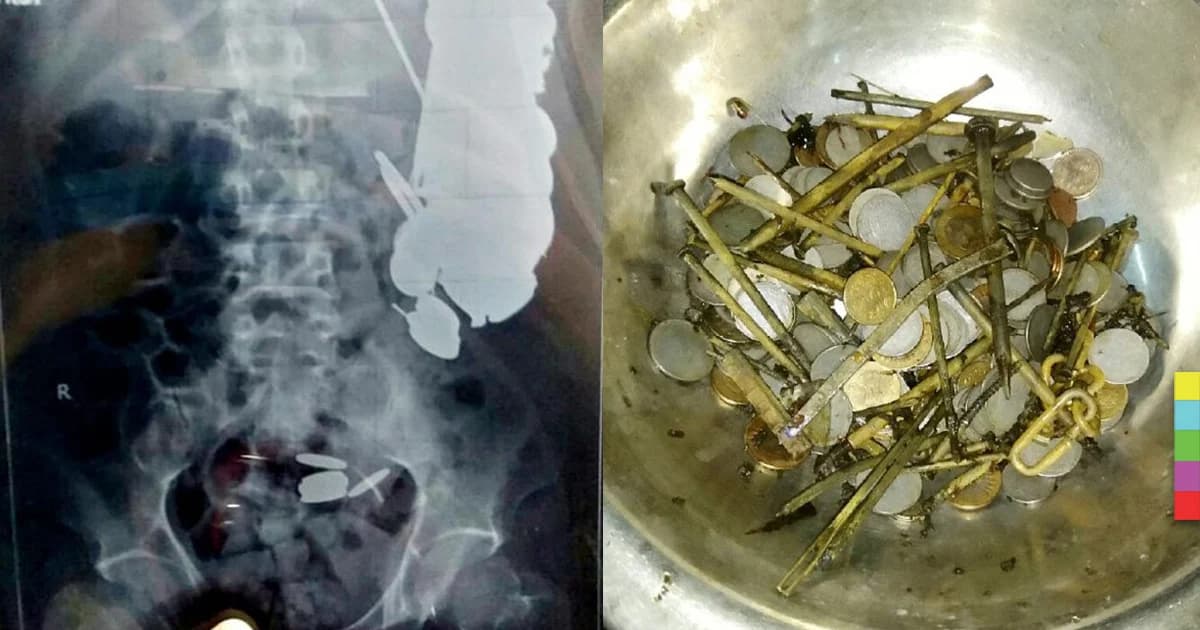 แพทย์พบ เหรียญ – ตะปู ในกระเพาะหนุ่มอินเดียกว่า 300 ชิ้น