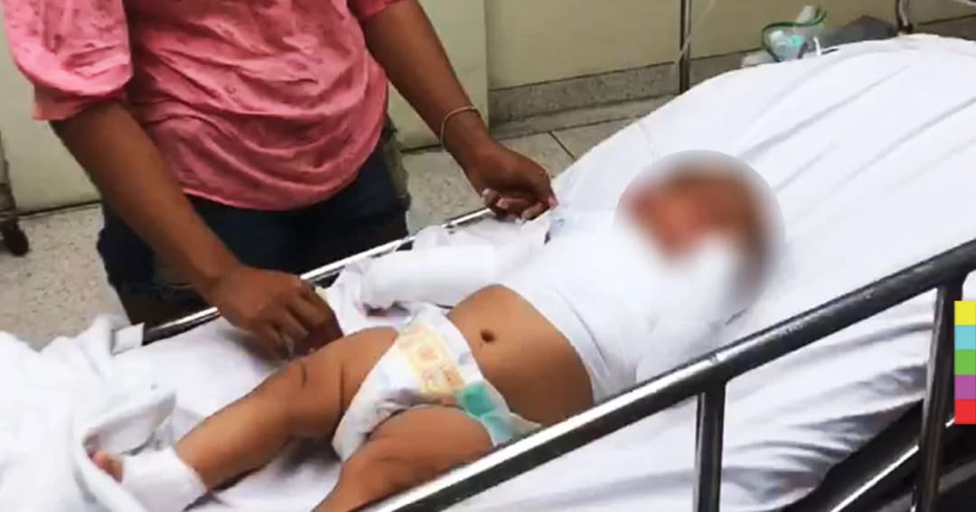 หนูน้อยวัย 7 เดือน ถูกข้าวต้มในกระทะไฟฟ้า กระเด็นใส่ใบหน้าและร่างกาย ได้รับบาดเจ็บ