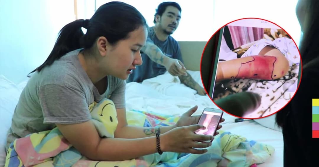 เตือน ! อันตรายจาก “แมลงก้นกระดก” หลังเด็ก 2 ขวบ เกิดแผลพุพอง มีไข้สูง