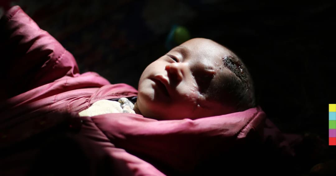 “ตาบอด 1 ข้าง” กลายเป็นสัญลักษณ์ที่บอกให้โลกรู้ ถึงความรุนแรงในซีเรีย