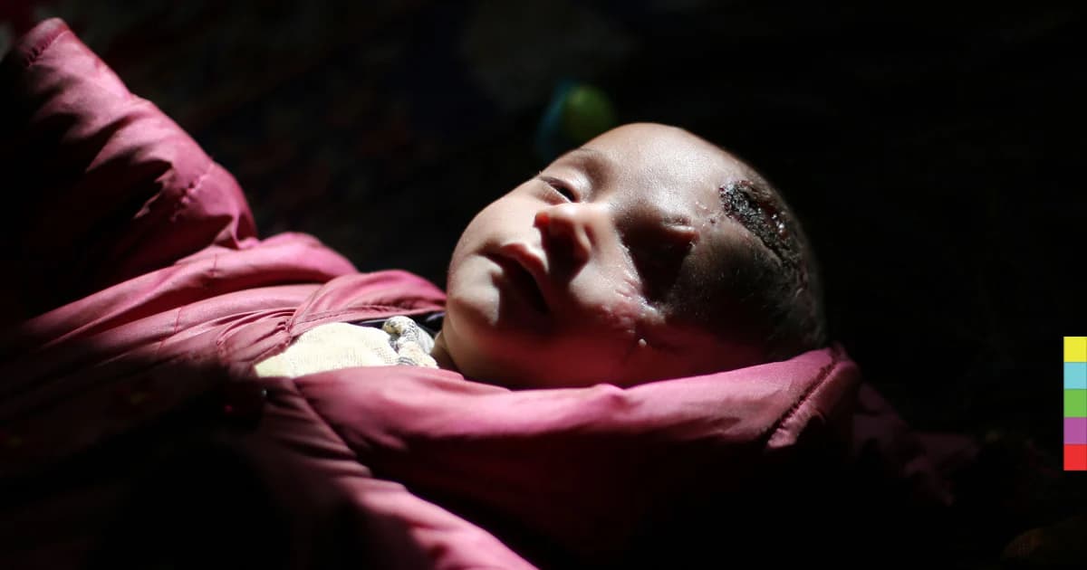 “ตาบอด 1 ข้าง” กลายเป็นสัญลักษณ์ที่บอกให้โลกรู้ ถึงความรุนแรงในซีเรีย