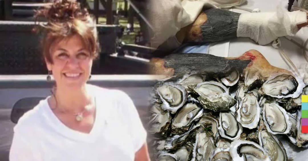 สาวมะกันกินหอยนางรมสดๆ ติดเชื้อแบคทีเรียจนขาเน่า ก่อนเสียชีวิต