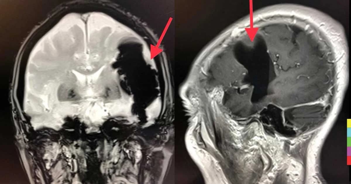 แพทย์เตือน บีบจมูก-เม้มปากขณะจาม เสี่ยง “ลมเข้าสมอง”