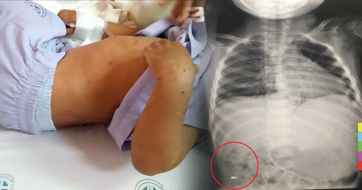 เร่งช่วยเด็ก 2 ขวบ แผลเต็มตัว เอกซเรย์เจอน็อตในท้อง