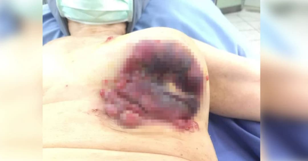 ดราม่าเดือด ! หลังเพจดังแฉภาพน่ากลัว เมื่อผู้ป่วยกิน “ยาหมอแสง” ได้ 6 เดือน