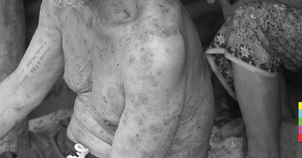 สุดทรมาน คุณตาป่วยแผลพุพองติดเชื้อทั้งตัว