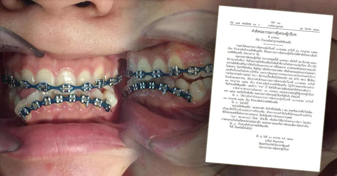 ห้ามขายสินค้าอุปกรณ์จัดฟันแฟชั่น ฝ่าฝืนคุก 10 ปี ปรับ 1 ล้าน