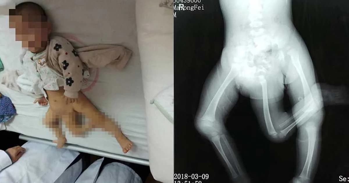 เด็กชายจีนเกิดมาผิดปกติ มี “ขาที่สาม” พบเพียง 1 ใน 500,000 เท่านั้น