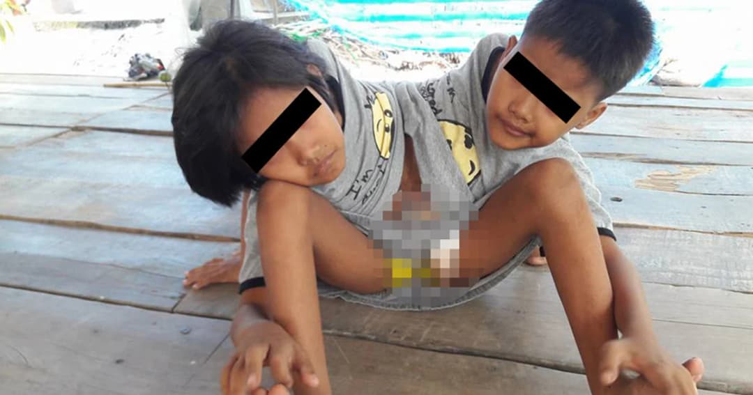 นักข่าวพื้นที่เผย “เด็กแฝดสยาม” ไม่ได้เดือดร้อนอย่างที่เป็นข่าว แถมเรียนเก่งด้วย