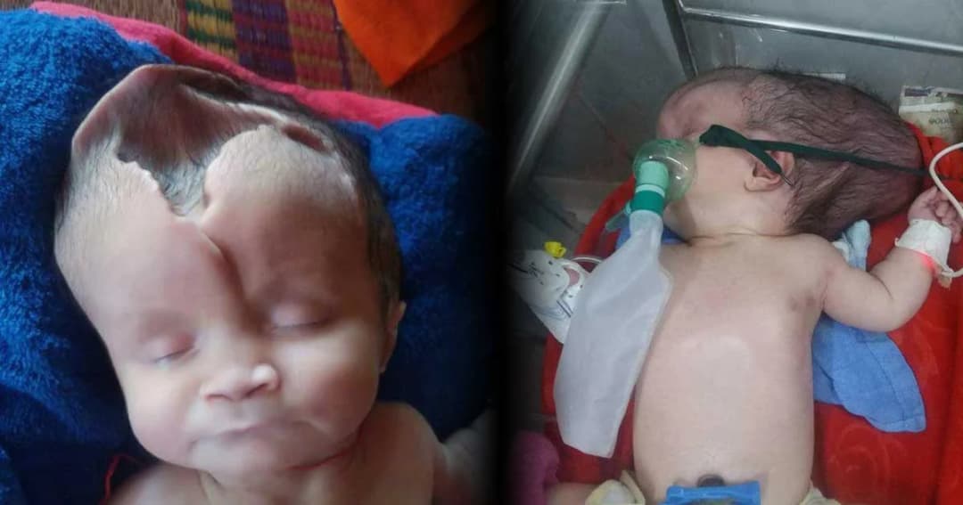 พ่อแม่ร้อง! เด็กหญิงชาวกัมพูชาเกิดมา “กะโหลกและสมองแหว่ง”