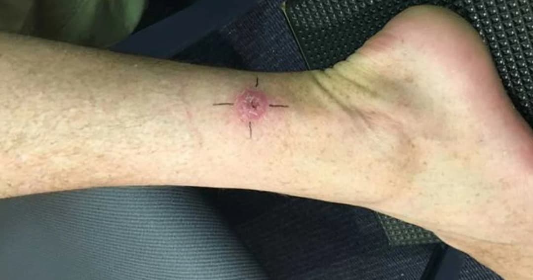 “แบคทีเรียกินเนื้อคน” ระบาดหนักในออสเตรเลีย แพทย์ร้องขอทุนทำวิจัย