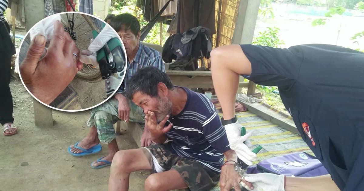 กู้ภัยลำปาง ช่วยชายวัย 50 ตัดแหวน 6 วงติดนิ้วเกือบเน่า