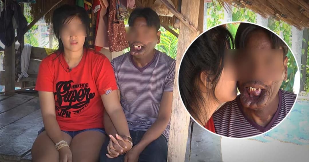 อิจฉากันทั้งบาง ! หนุ่มปากแหว่งเพดานโหว่แต่งสาวหน้าตาดี สินสอดไม่ต้อง มีแค่ความดี