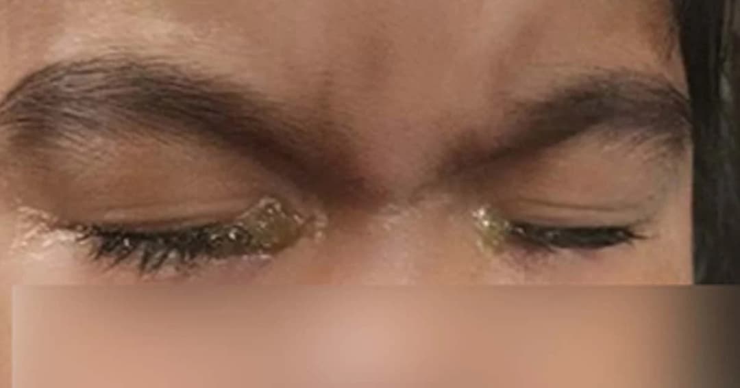 อุทาหรณ์เตือนพ่อแม่ปล่อยลูกเล่น แท็บเล็ต – มือถือนานๆ เกือบตาบอด