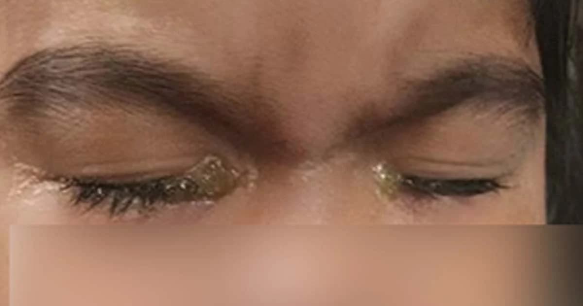 อุทาหรณ์เตือนพ่อแม่ปล่อยลูกเล่น แท็บเล็ต – มือถือนานๆ เกือบตาบอด