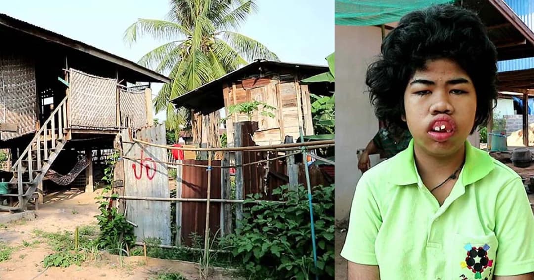 วอนช่วย “น้องปอ แก้วหน้าม้า” พิการใบหน้า ลมชัก