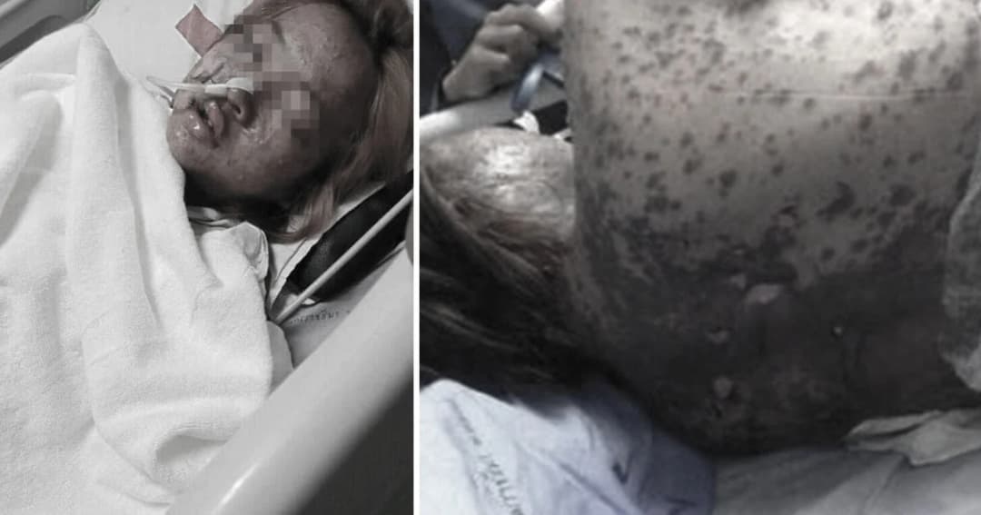 สาหัส ! สาวท้องแพ้ยารุนแรงจนต้องเสียลูก