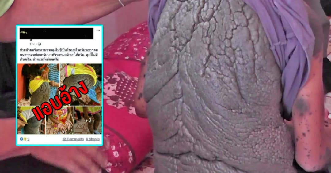 เตือนแอบอ้างนำรูปน้องนิ่ม ป่วยปานดำแข็งทั่วตัว-เป็นมะเร็ง ไปโพสต์เฟซเรี่ยไรเงิน