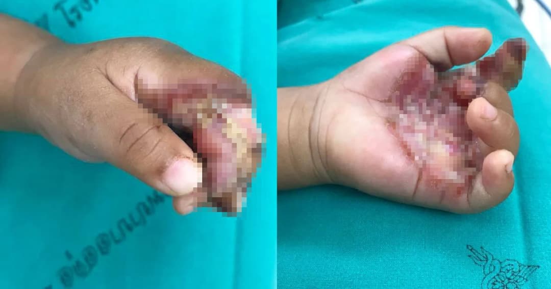 หมอ รพ.สตูล โพสต์อุทาหรณ์ ! “น้ำลายหมอบ้าน” ทำนิ้วเด็กแทบเน่า