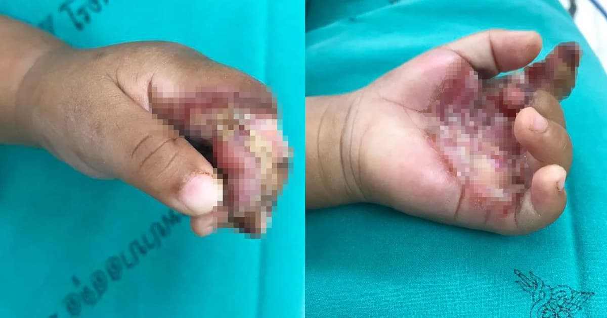 หมอ รพ.สตูล โพสต์อุทาหรณ์ ! “น้ำลายหมอบ้าน” ทำนิ้วเด็กแทบเน่า