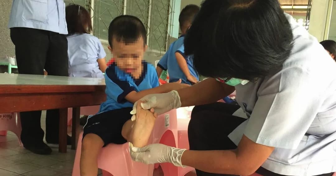 ระบาดหนัก ! โรคมือเท้าปาก พบ นร.ยะลา ป่วยแล้ว 13 ราย