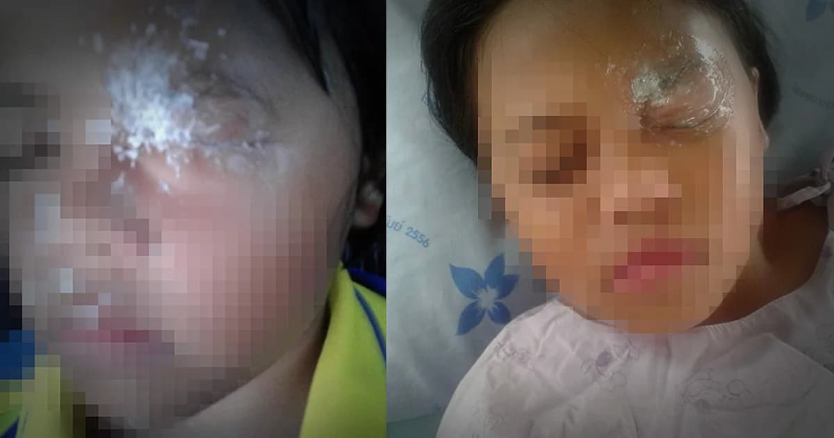 อุทาหรณ์ ! ด.ญ. 9 ขวบ กาวร้อนกระเด็นเข้าตา หวิดบอด