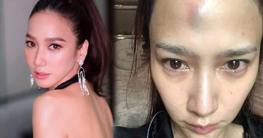 ฟาดเคราะห์!! “อั้ม พัชราภา” โดนสันตู้ตกใส่หน้าผากจนบวมเขียว