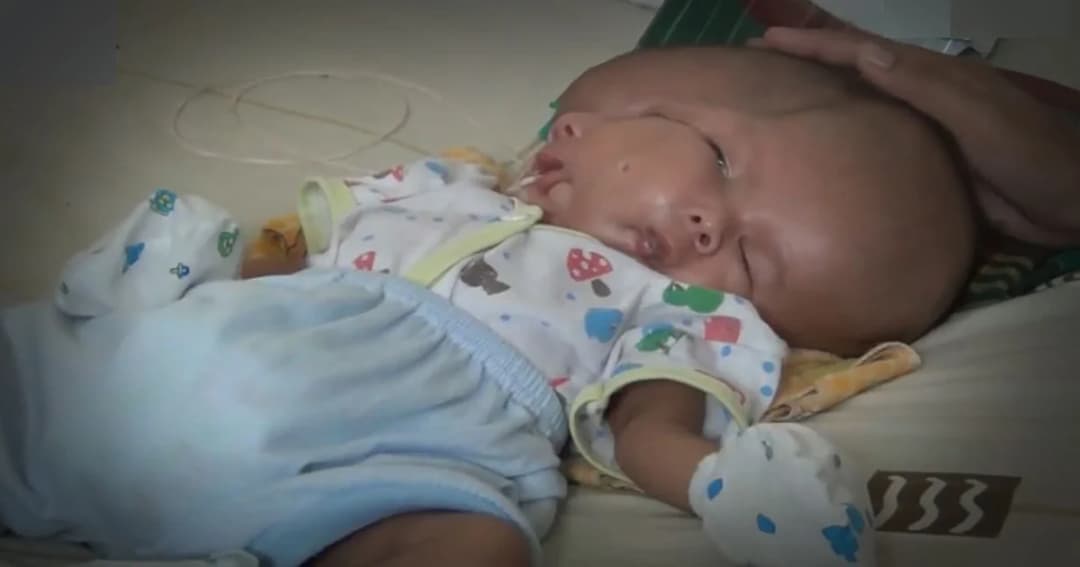 อยู่ได้อีกไม่นาน ! ทารกแฝดใบหน้า–สมองติดกัน แต่มีศีรษะเดียว