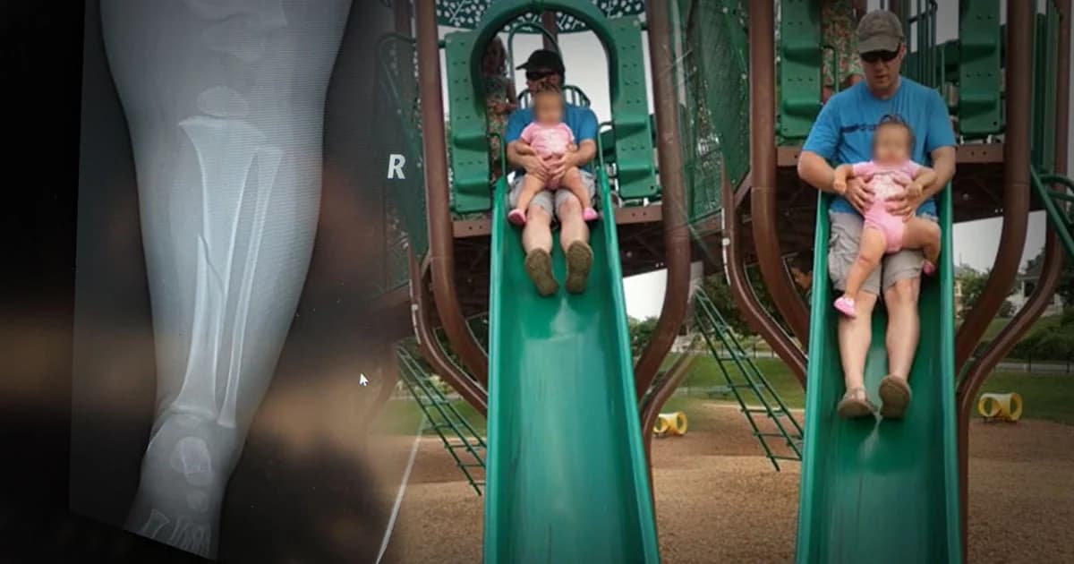 อุทาหรณ์ ! เด็กน้อย 14 เดือน ขาหัก เพราะพ่อพาเล่นสไลเดอร์