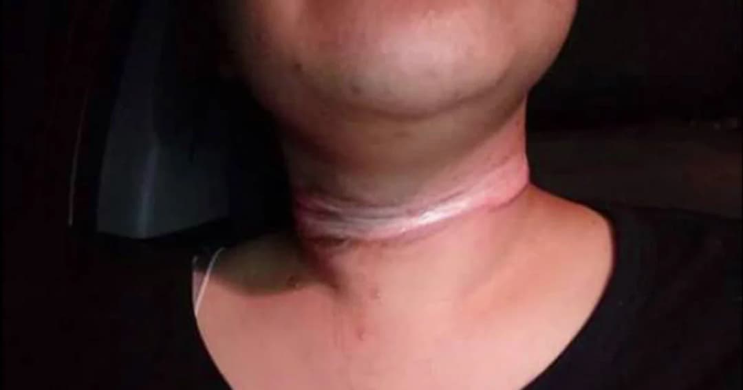 หวิดคอขาด ! สาวร้องโดนสายเคเบิ้ลเกี่ยวคอ วอนคนรับผิดชอบ