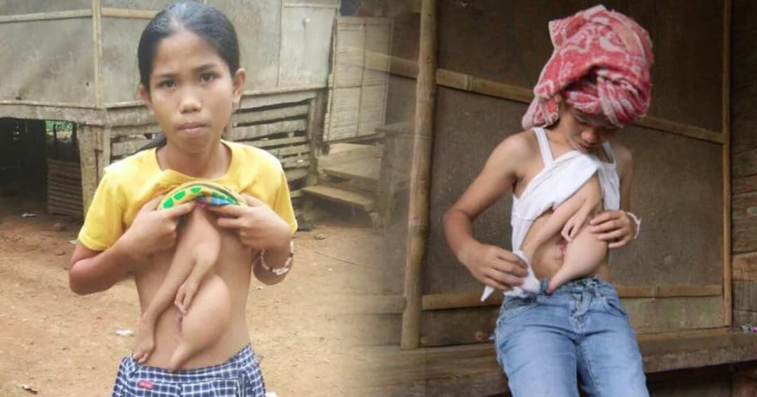 ด.ญ.ฟิลิปปินส์น่าสงสาร มีแขนแฝดงอกติดตัว เตรียมมาผ่าตัดที่ไทย