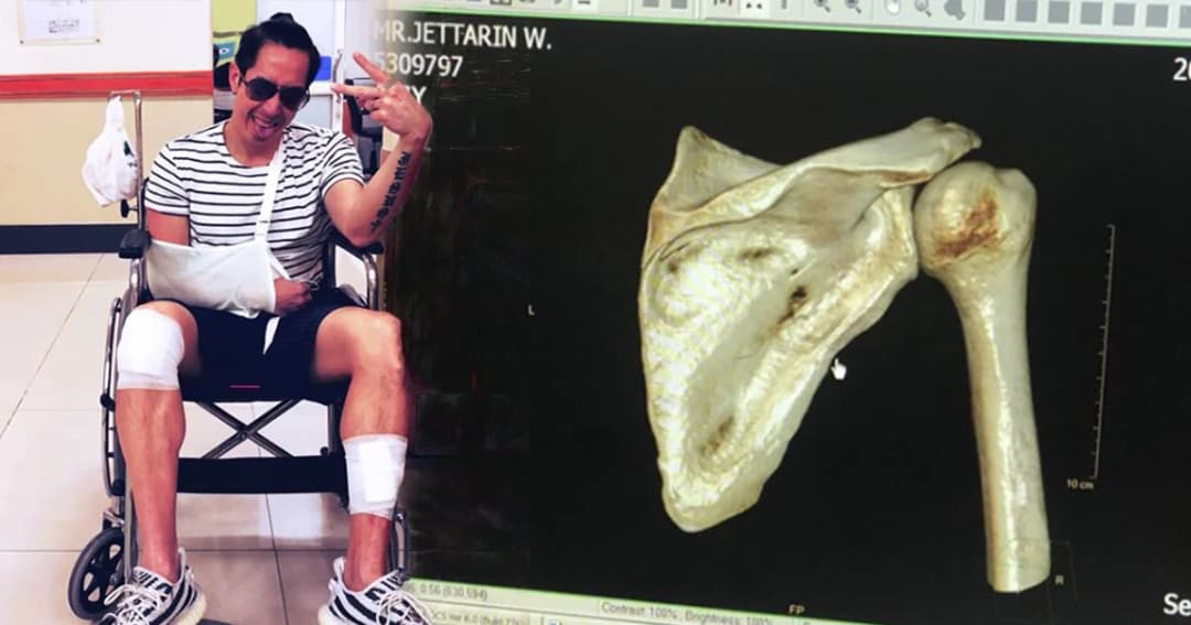 สายแว้น! “เจ เจตริน” เกิดอุบัติเหตุขี่จยย.ล้ม กระดูกสะบักหลังแตก