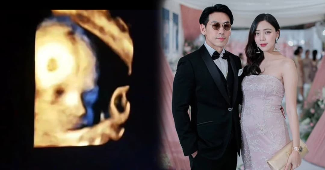 “นิวเคลียร์” เผยภาพอัลตราซาวด์ “น้องไทก้า” จมูกโด่งมาก!