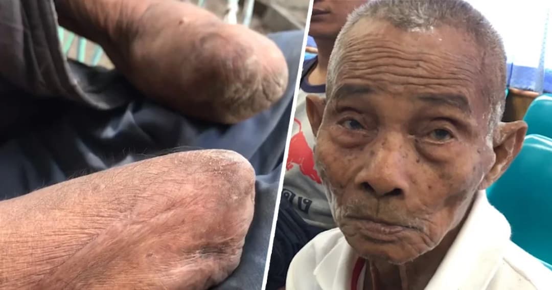 พ่อเฒ่าเมืองช้างวัย 82 ฟั่นเฟือน-แขนขาด ไร้สวัสดิการชีวิต สุดดีใจหลังปลัดฯ นัดทำบัตร ปชช.