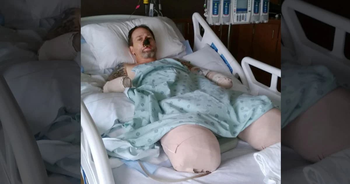 ชายมะกันโชคร้ายเสียแขน ขา จมูกเพราะติดเชื้อในกระแสเลือดจากน้ำลายหมา