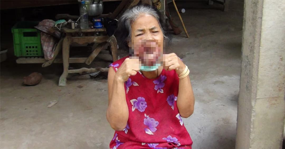 วอนช่วย หญิงชราป่วยเป็นมะเร็งที่ปาก อาศัยอยู่กับสามีป่วยอัมพฤกษ์