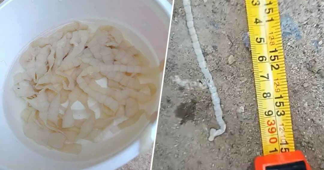 แพทย์เผย ‘พยาธิขึ้นสมอง’ อันตรายถึงชีวิต หลังสาวเปิดคลิป พยาธิยาว 4 ม. อยู่ในลำไส้