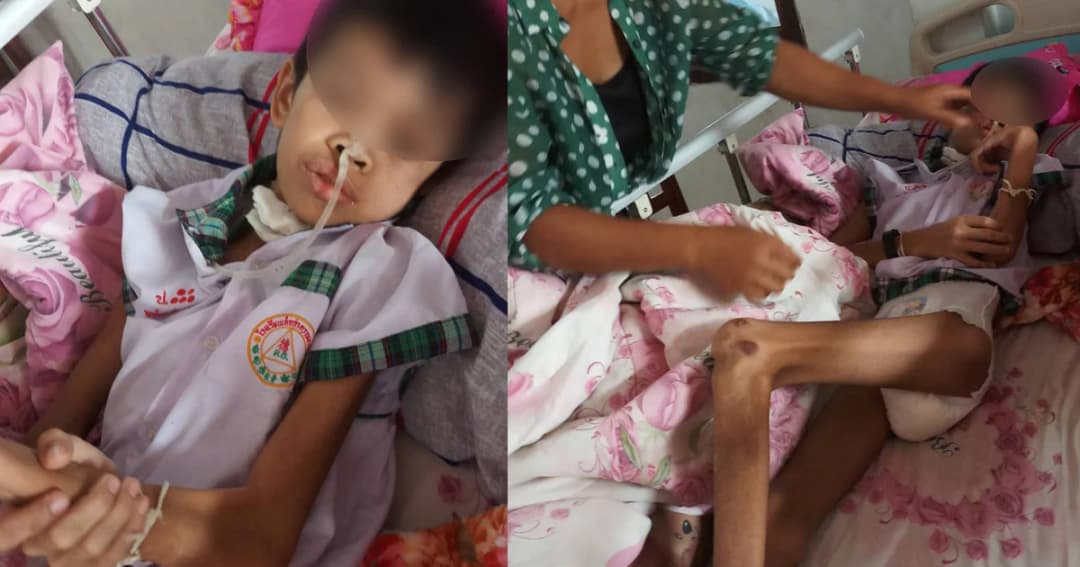 วอนช่วย ! “น้องโอ๊ต” วัย 11 ถูกรถ 6 ล้อชน เลือดออกในสมอง กลายเป็นผู้ป่วยติดเตียง