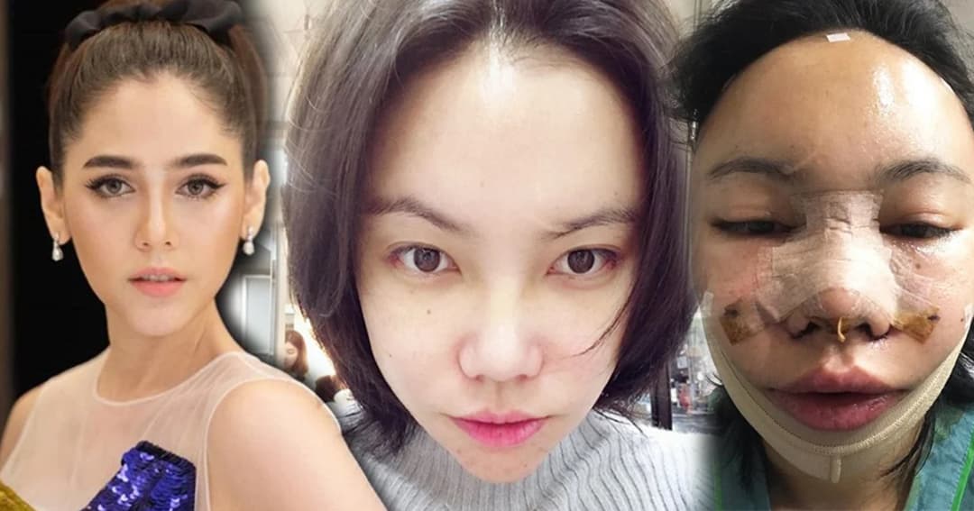 สวยชาตินี้! “เอ็มมี่” ตัดไหมพร้อมกลับไทย หลังบินไกลทุบหน้าให้เหมือน “ชมพู่”