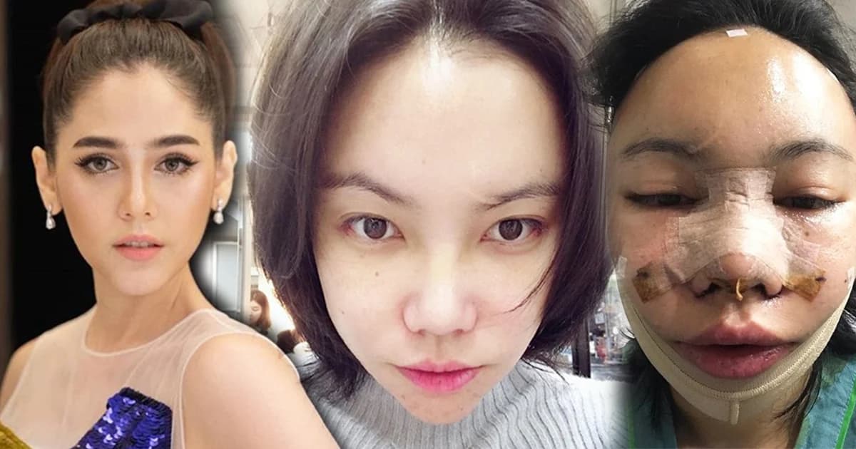 สวยชาตินี้! “เอ็มมี่” ตัดไหมพร้อมกลับไทย หลังบินไกลทุบหน้าให้เหมือน “ชมพู่”